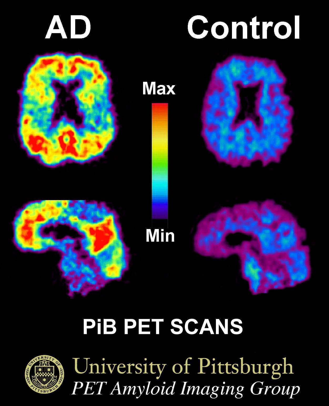 PET brain scans comparing amyloid tracer uptake in Alzheimer's disease and normal aging.