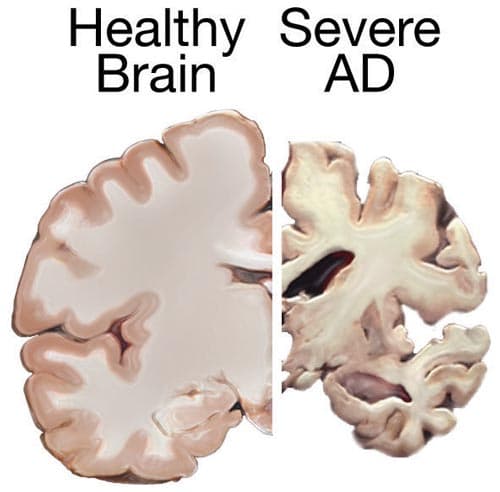 Comparison of a healthy brain and a brain affected by Alzheimer-related dementia.