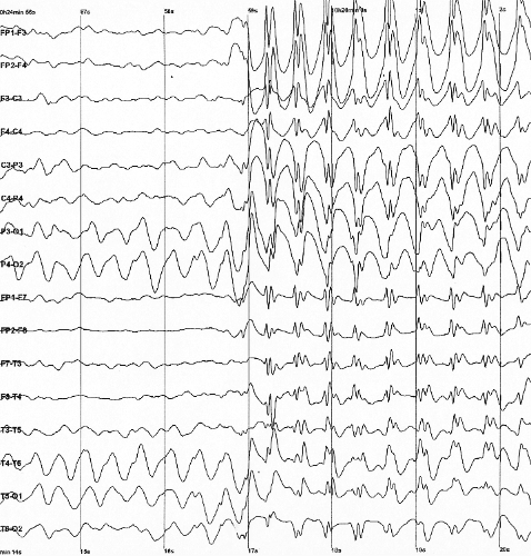 EEG tracing showing spike-wave activity associated with epilepsy.